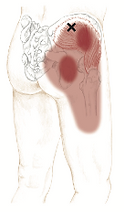 trochanteric pain syndrome figure